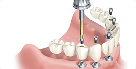Dentist Rehabilitation