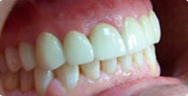 Porcelain Veneer
