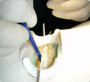 Dental Bleaching