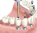 Dental Rehabilitation